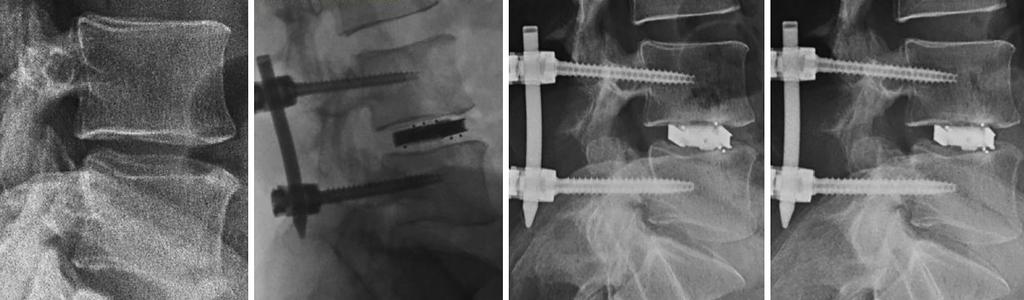 Journal of Spine Surgery, Vol 4, No 1 March 2018 A 65 B C D Figure 4 Representative (A) preoperative, (B) intraoperative, (C) 12-month, and (D) 24-month postoperative lateral radiographic images of a