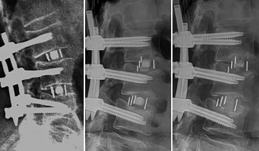 Journal of Spine Surgery, Vol 4, No 1 March 2018 A 69 B C Figure 8 (A) Fluoroscopic, (B) 6-month postoperative and (C) 24-month postoperative lateral plain film radiographic images of subsidence at