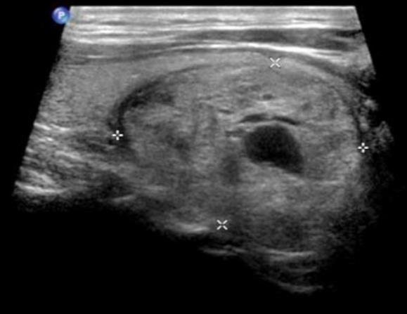 Original Ultrasound image Detection and qualitative diagnosis of a thyroid nodule using Deep Learning