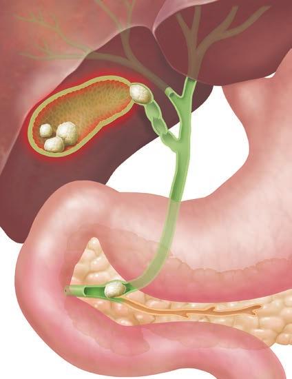 When Gallstones Form Most gallbladder problems are caused by gallstones. These form when substances in the bile crystallize and become solid. In some cases, the stones don t cause any symptoms.