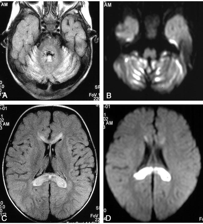 AJNR: 25, August 2004 NEUROAXONAL DYSTROPHY 1271 FIG 2. Images obtained in a 19-monthold male patient.
