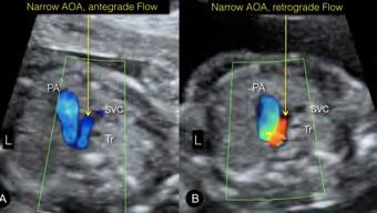 Aortic arch right or left-sided?