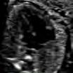 Atypical vessels (left persistent -