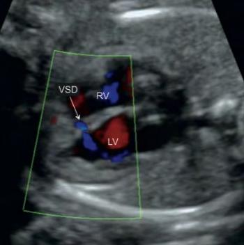 Normal Ventricular Septum ook for the T sign in apical views Insonate the septum at 90 degrees for optimal diagnosis of muscular and perimembranous VSD Color