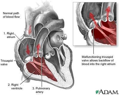 The Right Ventricle The pulmonary valve is situated at the top of the infundibulum.