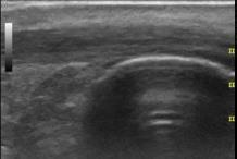 Sonographic Appearance Striated