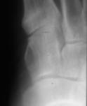 Stress fractures Fatigue Abnormal stress on normal bone