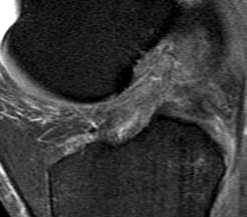 Imaging Bone marrow edema Curvilinear subchondral