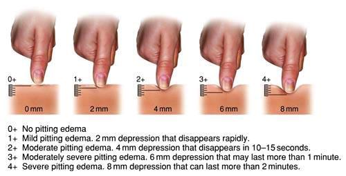 EDEMA ASSESSMENT PHYSICAL ASSESSMENT TALKING POINTS We have muscles between our fingers called the interosseous muscle. This muscle is largest between our thumb and forefinger.