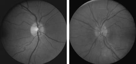 2010; 128: 705-711 Other fundus findings Peripapillary haemorrhages Terson s syndrome Retinal / choroidal folds Macular star / hemi-macular star Absence