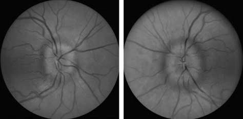 Red-free filter on direct ophthalmoscopy Ensure patient not breath-holding Explanation of SVP s (in 85% of normals) Blood flows high pressure -> low