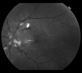 Important for: Preventing vision loss Monitoring ICP Case 2 38 yo