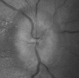 dysphasia) Severe disc oedema (florid papilloedema and haemorrhages, ischaemic changes, macular star) Malignant hypertension Management Risk of life-threatening disease (SOL, malignant HT) Risk of