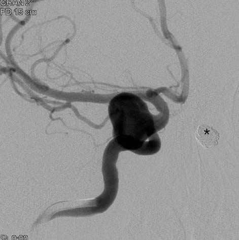 Byung Moon Kim, et al. efficacy [1-3]. Furthermore, even with stent assistance, coiling is very difficult to perform and especially risky in blister-like, dissecting, or fusiform aneurysms [11-13].