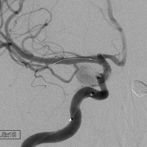 The Pipeline, a stent-like endoluminal device with high metal density, was invented for the treatment of aneurysms by flow diversion without coiling, and has been shown to have promising results for