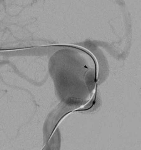 The perforator infarction rate was 3%, with significantly lower odds of perforator infarction among patients with aneurysms of the anterior circulation as compared with those of the posterior
