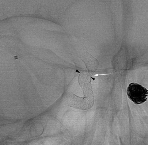 Although the risks of procedure-related morbidity and mortality are not negligible, the treatment of intracranial aneurysms with flow-diverters is feasible and effective with high A B C D E F Fig. 1.
