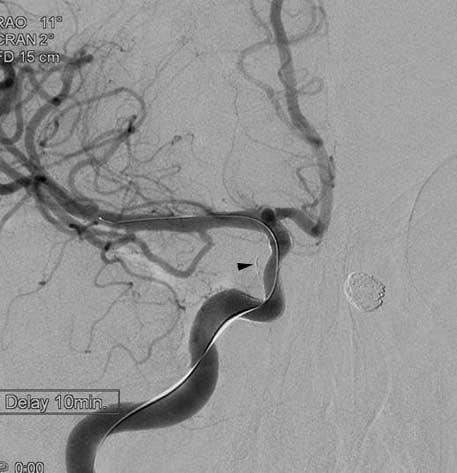 Pipeline Embolization Device for Large/Giant or Fusiform Aneurysms G H Fig. 1. G. After using a balloon for the apposition of the second Pipeline, the aneurysm sac was no longer visualized.
