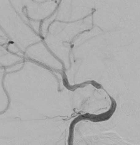 The left anterior cerebral artery was supplied via the anterior communicating artery from the left internal carotid artery (not shown). J.