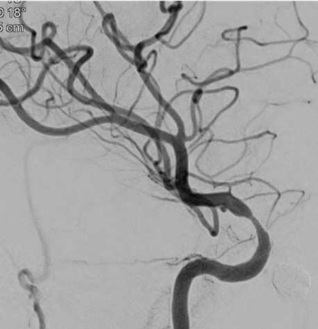 I J complete occlusion rates, especially considering the fact that flow-diverters have mainly been used for the treatment of aneurysms that are large/giant in size, uncoilable, or have failed prior