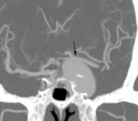 Byung Moon Kim, et al. A B C D E F Fig. 2. A 67-year-old woman presenting with third and sixth cranial nerve palsies and a recently aggravated intractable headache. A. The coronal MIP reconstruction image of the CT angiogram shows a giant aneurysm at the left internal carotid artery, cavernous segment.