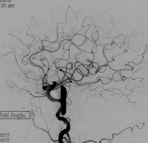 A source image of the 3-month follow-up CT angiogram shows that the aneurysm was completely thrombosed.