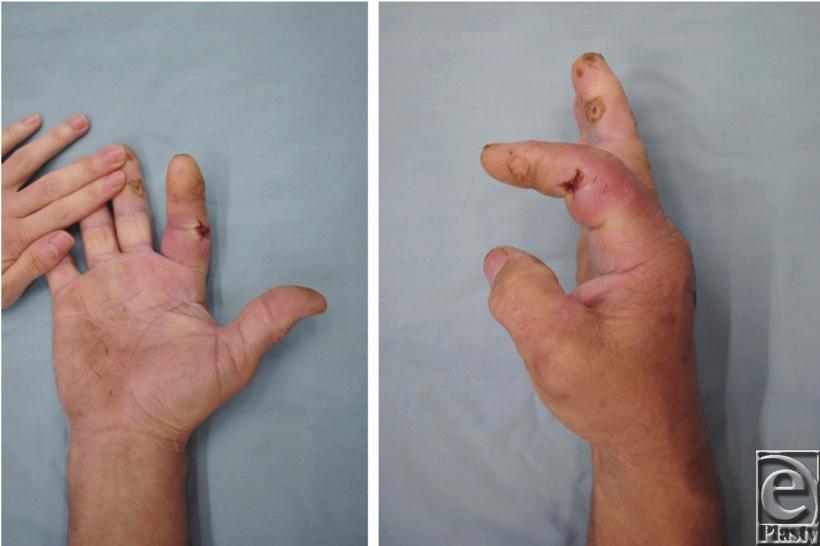 Figure 1. Anteroposterior (a) and lateral (b) photographs demonstrating fusiform swelling and flexed posture of the right index finger.
