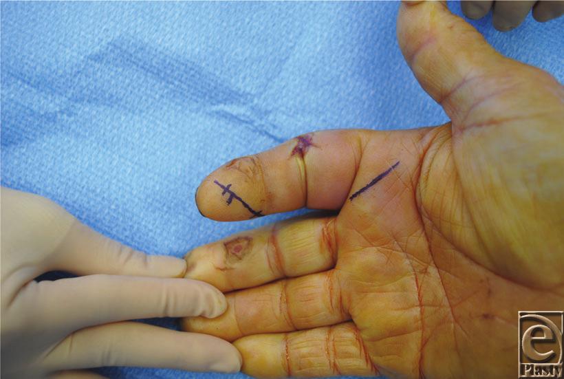 Figure 2. Surgical markings for closed tendon sheath irrigation overlying the A1 pulley and distal phalanx to allow for proximal and distal access of the flexor sheath.