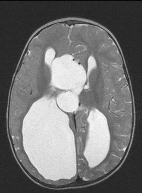 Interhemispheric cyst Commonly seen in patient with corpus callosum agenesis and other midline
