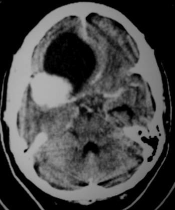 meningioma, schwannoma, craniopharyngioma It has SI similar