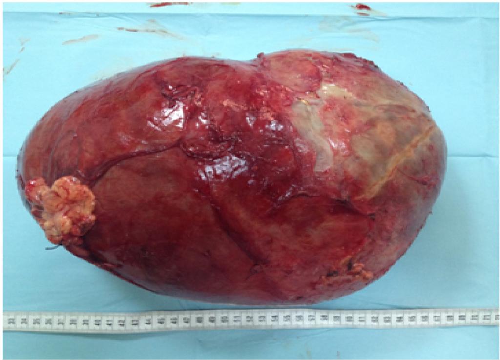 Figure 4. The giant abdominal cyst totally removed 14].