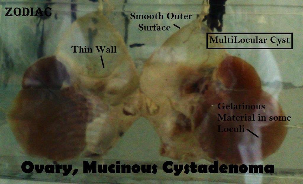 - The specimen is a large multilocular thick walled cyst.
