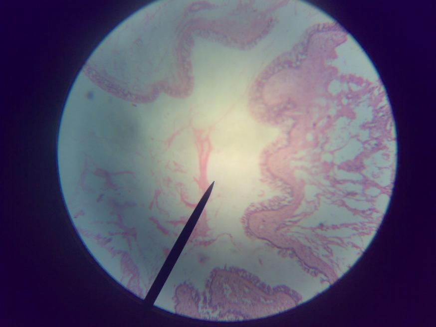vacuolated foamy macrophages (Mikulicz cells) beneath the squamous mucosa.