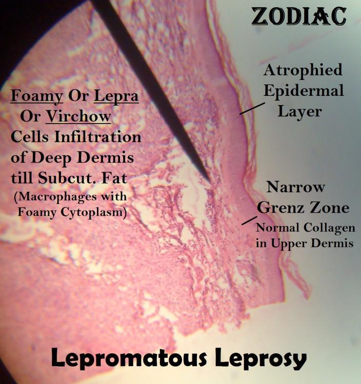 epidermal layer Upper dermis Narrow (Grenz zone) normal collagen