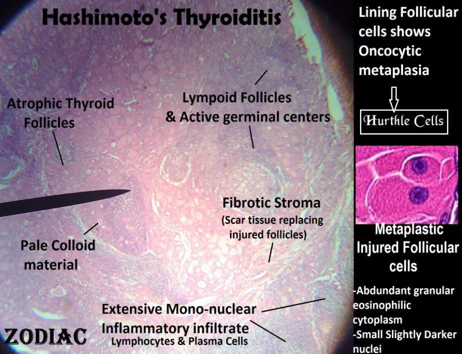 2- Hashimoto's Thyroiditis Granuloma Sections of the thyroid gland