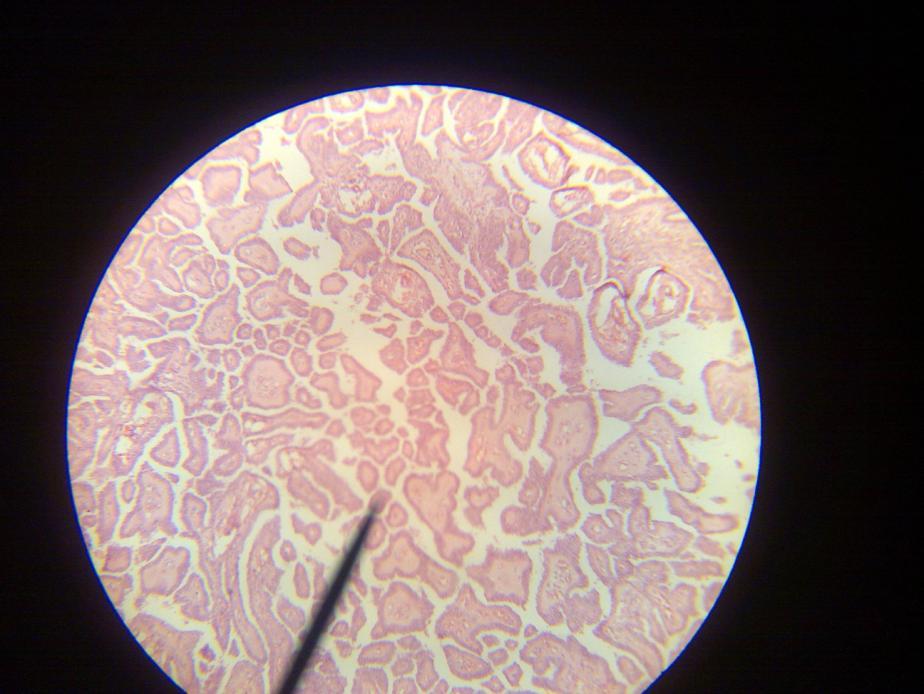 The thyroid follicles are lined by flat (low cubical epithelium.