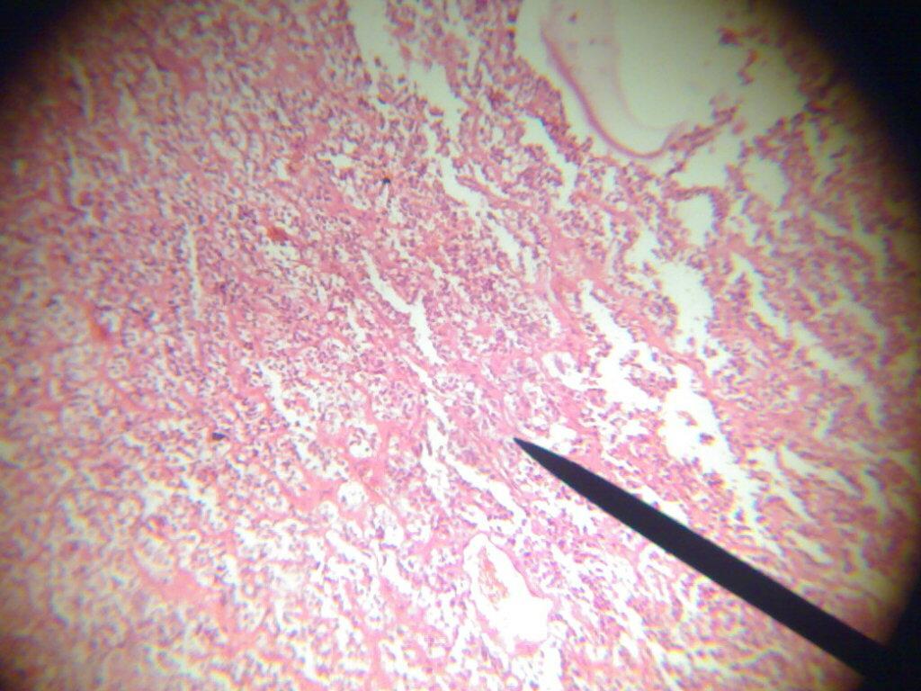 5- Pituitary Adenoma Uniform cells arranged in cords Section examined showed tumor tissue