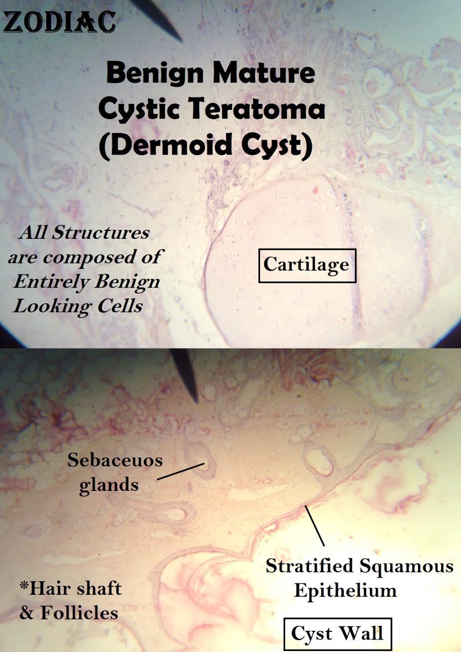 Structures from the other germ layers also could be identified such as cartilage, bone and thyroid