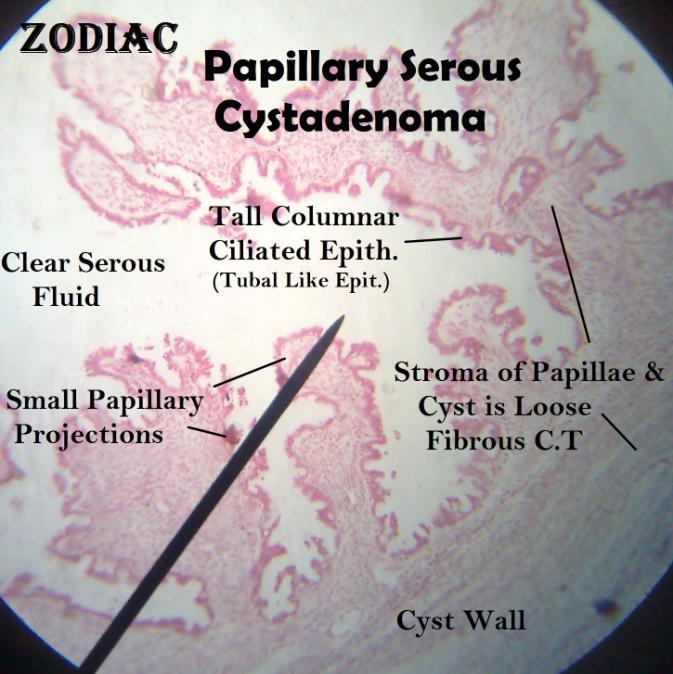 4- Papillary Serous Cystadenoma The cyst wall 1- is lined by tall columnar epithelial cells and is filled with clear