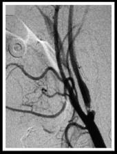 The Road to Carotid Artery Stenting Acceptable alternative to CEA is CAS with embolic protection among symptomatic patients with a stenosis of 70-99% or those with high-risk factors and stenosis of