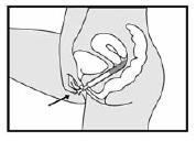 Remove the applicator from the tube and replace the cap on the tube - Inserting the applicator: Hold the filled applicator by its barrel and gently insert the applicator into the vagina as far as it