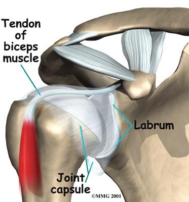 The soft labral tissue can be caught between the glenoid and the humerus. When this happens, the labrum may start to tear.