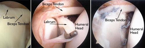 (Left) An arthroscopic view of a healthy labrum. (Center) In this image, the surgeon uses a small instrument to evaluate a large SLAP tear. (Right) The labrum has been reattached with sutures.