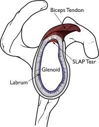 SLAP Tears A SLAP tear is an injury to the labrum of the shoulder, which is the ring of cartilage that surrounds the socket of the shoulder joint.