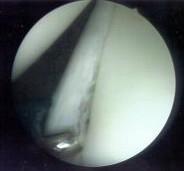 The term dislocation implies that the ball (humeral head) displaces completely from the glenoid (socket) whereas subluxation implies that the degree of displacement is less than dislocation in other
