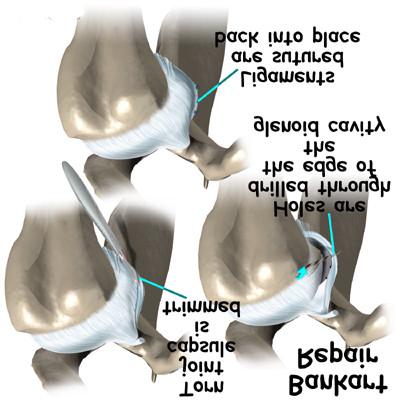If the history is of traumatic dislocation then the primary aim will be reattachment of the torn labrum ligaments and capsule to the front of the glenoid using suture anchors.