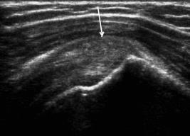 Ultrasound TREATMENT 31 32 Atraumatic Shoulder Pain A Tendon Problem Arthritis Stability Stiffness Instability TREATMENT: TENDON 33 34 Rotator
