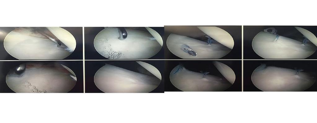 Fig 7 d. Intra-operative photographs of arthroscopic labral repair using suture anchors to refix the torn labrum to the bony rim of the acetabulum.