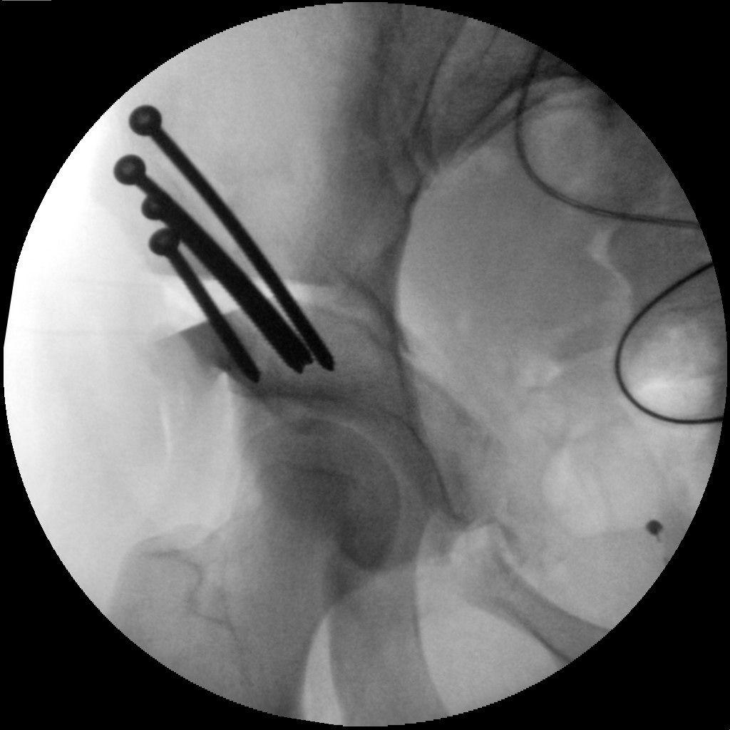 Peri-acetabular means around the acetabulum and osteotomy comes from osteo, meaning bone and otomy meaning cutting. So translated literally the operation means: Around the acetabulum bone cutting.