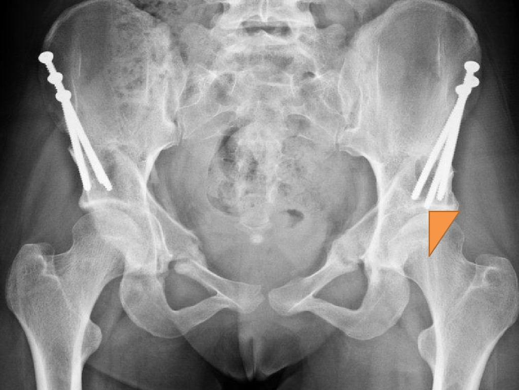 the acetabulum. The screws for initial stabilization remain in position. In Fig. 9 c the bony cuts in the pelvis have healed and the screws have been removed 3.